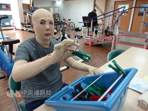56岁的阿和双手和脸部严重烧伤，每天咬紧牙关忍痛坚持锻炼，希望早日重返职场，赚钱养家，给家人安稳生活。台湾“中央社”记者陈朝福摄