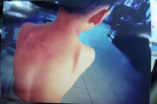 男童背部被打的红肿疼痛。台湾《联合报》记者许政榆/翻摄